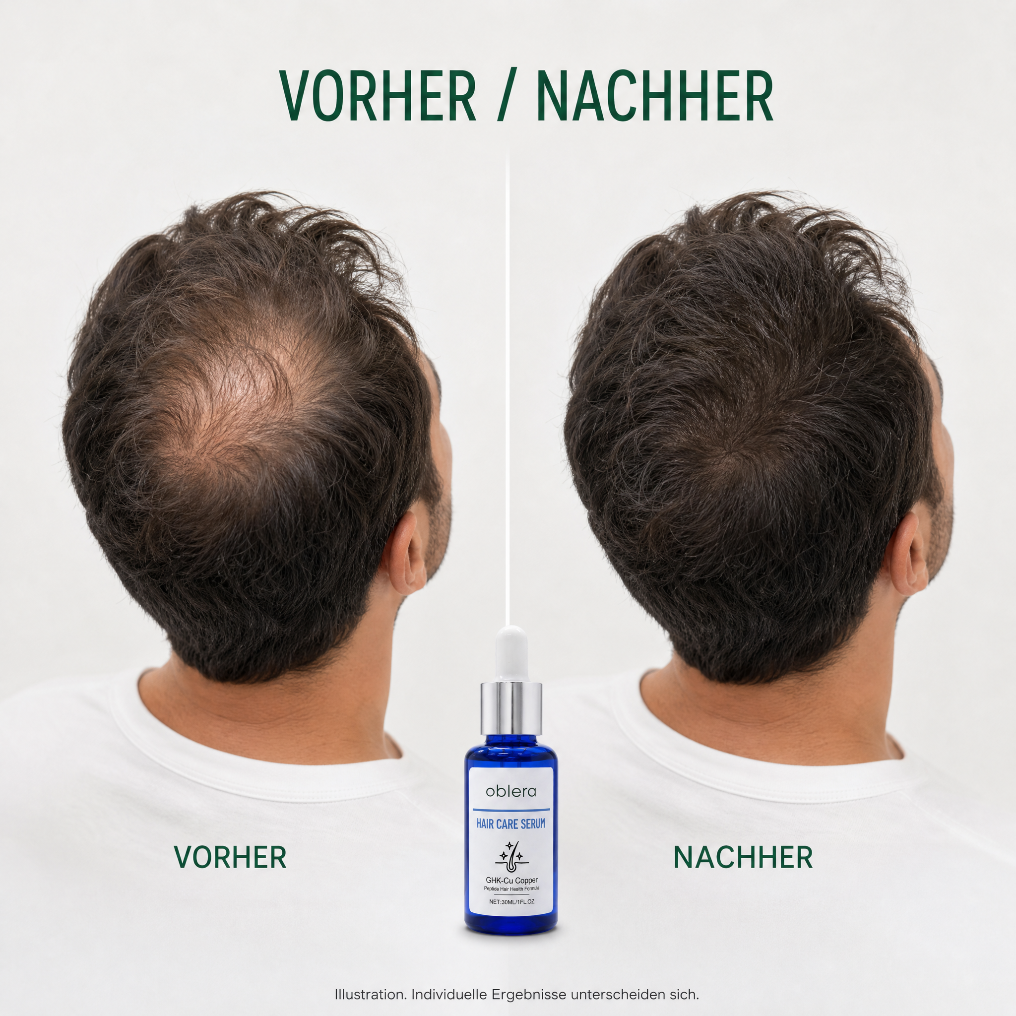 Illustration Vorher/Nachher am Oberkopf, individuelle Ergebnisse unterscheiden sich